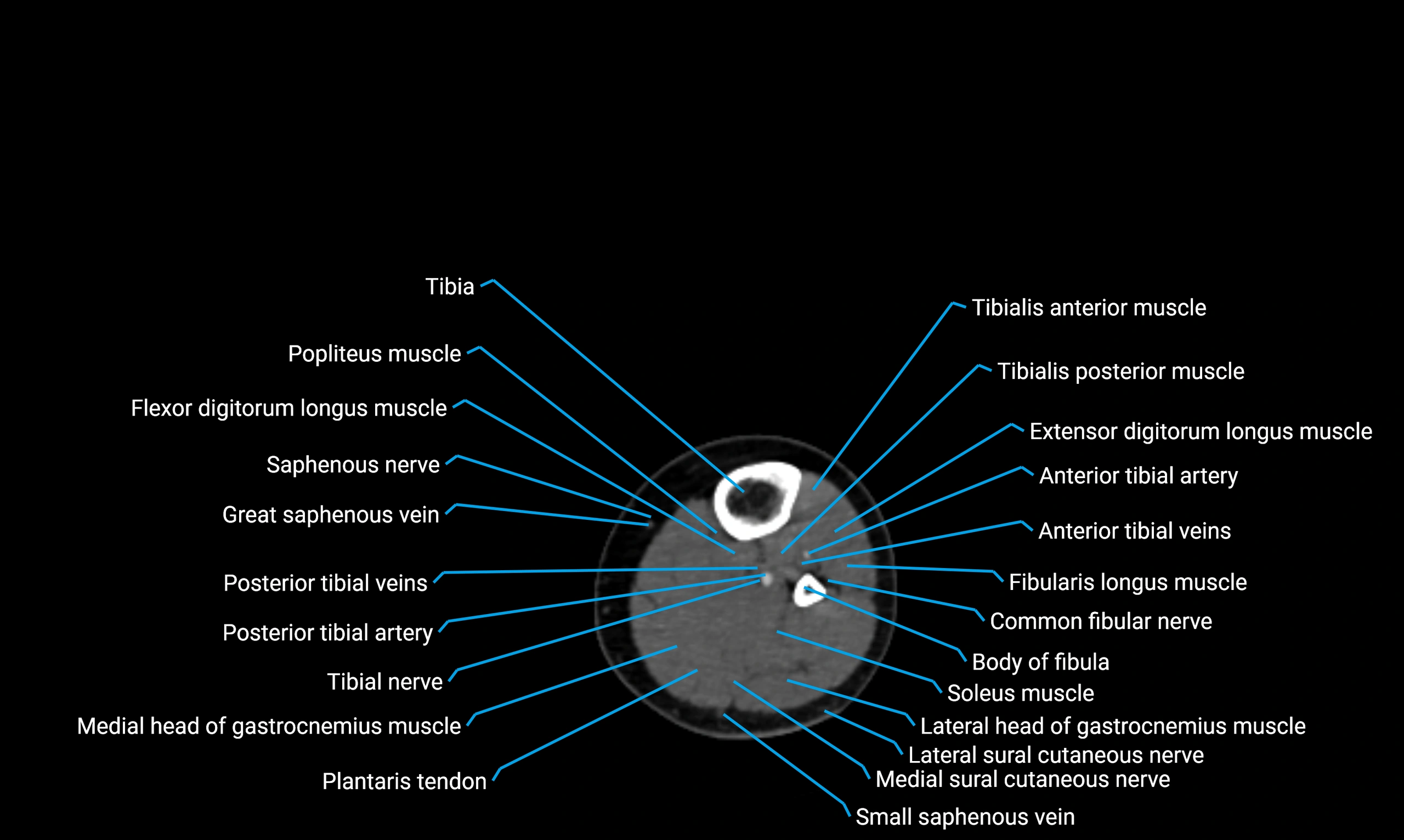 CT lower limb axial cross sectional anatomy labelled image 105 (2).webp